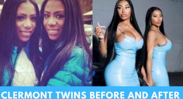 After Plastic Surgery, What Do The Clermont Twins Look Like Before And After-Featured